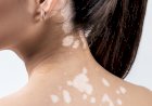 Pessoas com vitiligo terão prioridade em dermatologistas e psicólogos