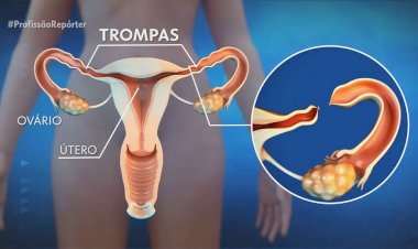 STF julga legalidade de lei que restringe laqueadura e vasectomia